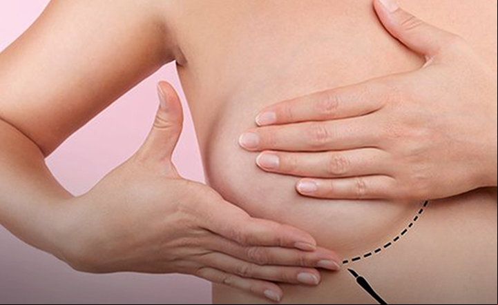 Mulher vítima de câncer ganha cirurgia reparadora de mama no SUS 